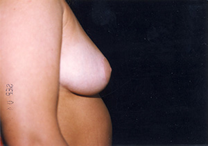 Breast Reduction 2d
